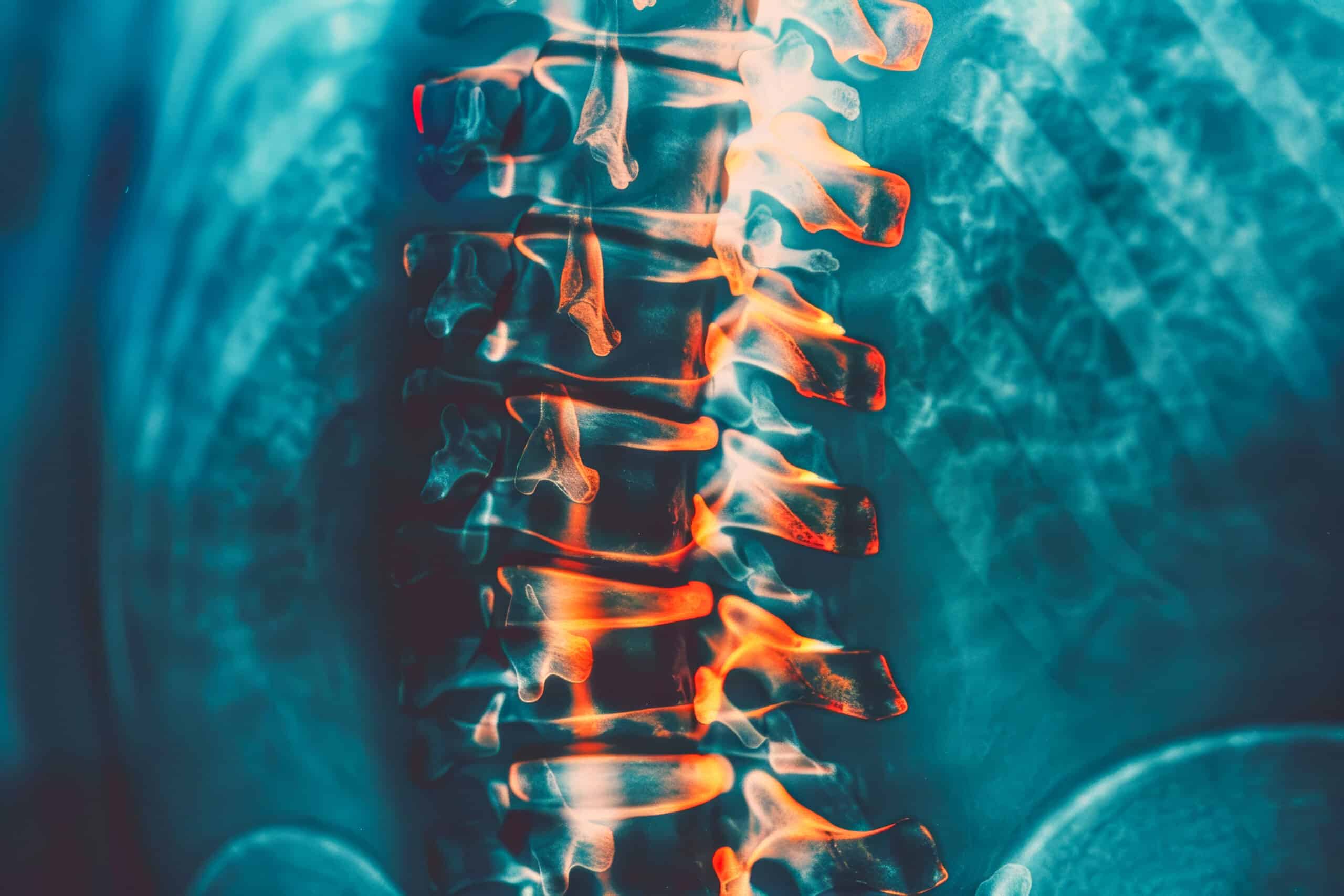 Spinal Cord Injury and Medical Cannabis